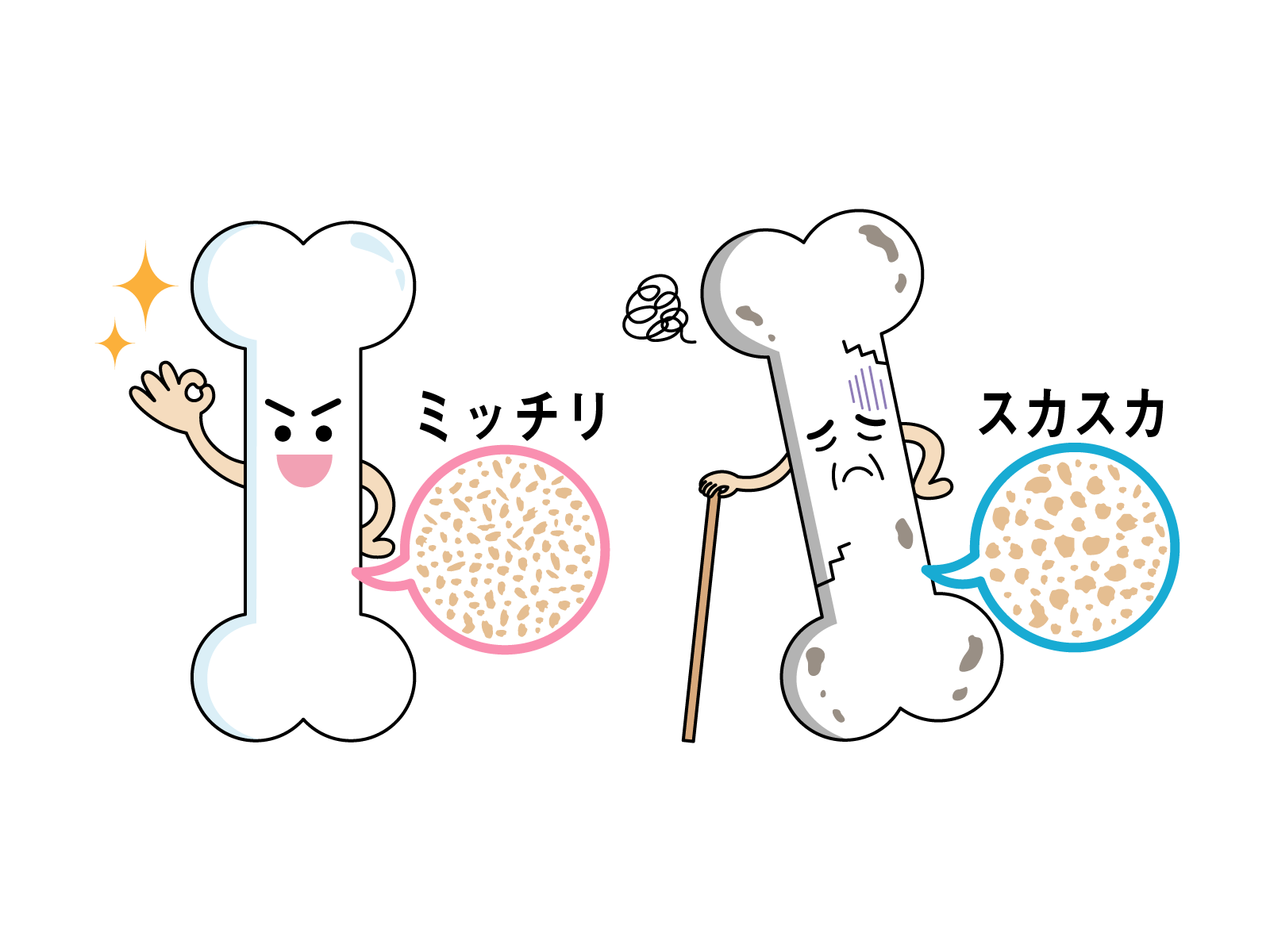 骨粗鬆症のイメージ図